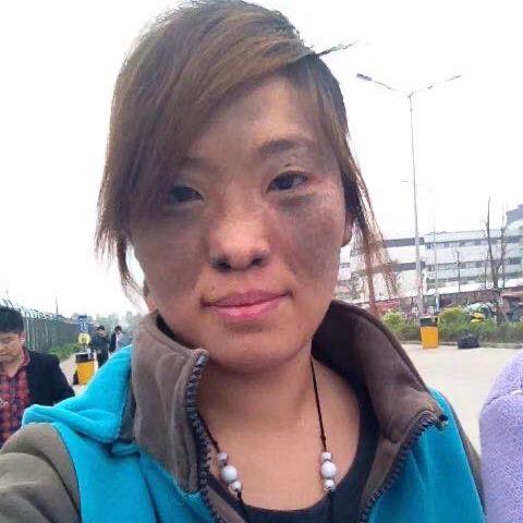 带了26年的胎记女孩（鹰哥）