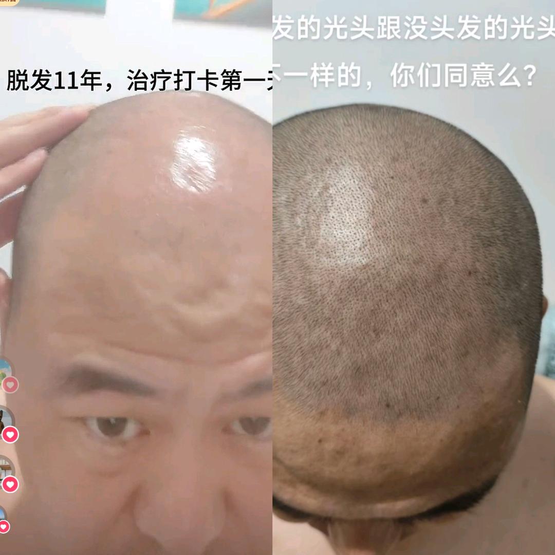 杨老二（地中海七级脱发）